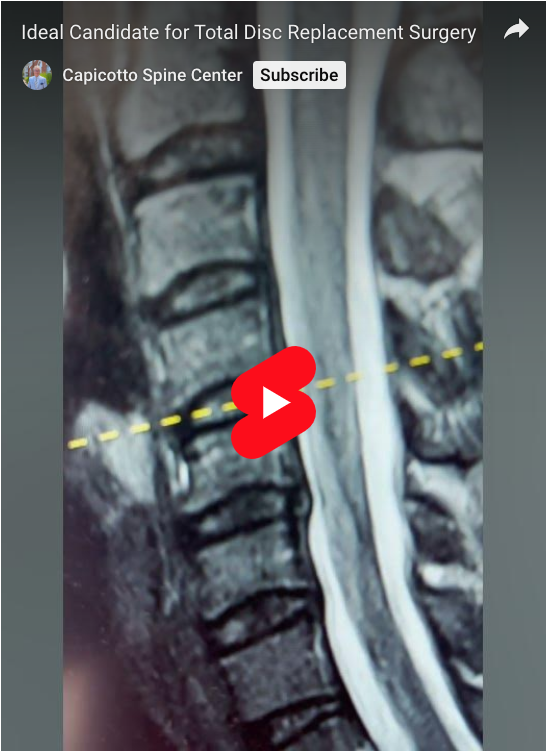Read more about the article Ideal Candidate for Total Disc Replacement Surgery