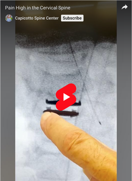 Read more about the article Pain High in the Cervical Spine