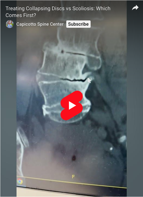 Read more about the article Treating Collapsing Discs vs Scoliosis: Which Comes First?