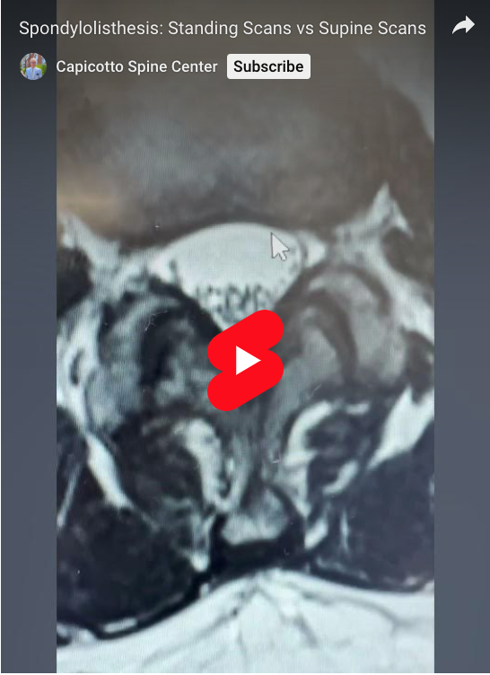 Read more about the article Spondylolisthesis: Standing Scans vs Supine Scans