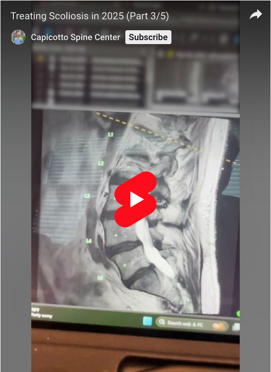 Read more about the article Treating Scoliosis in 2025 (Part 3/5)