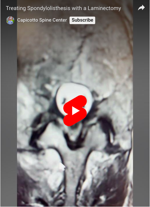 Read more about the article Treating Spondylolisthesis with a Laminectomy