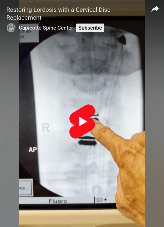 Read more about the article Restoring Lordosis with a Cervical Disc Replacement