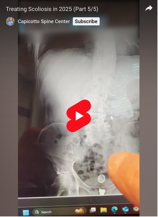 Read more about the article Treating Scoliosis in 2025 (Part 5/5)