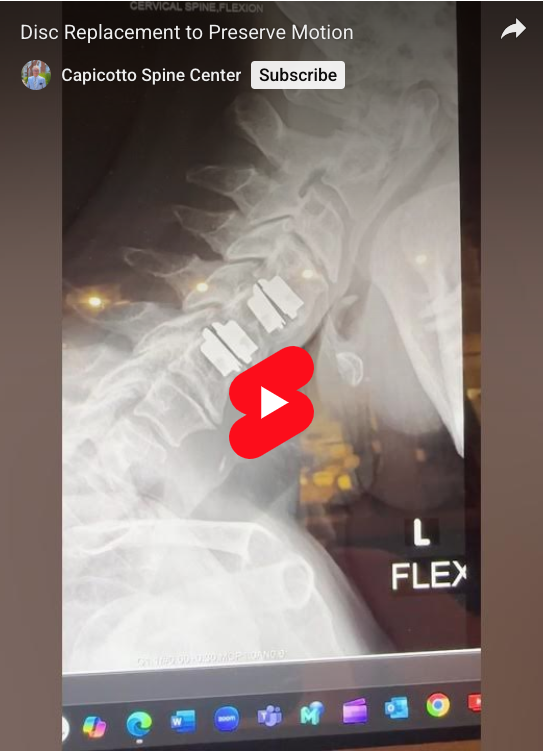 Read more about the article Disc Replacement to Preserve Motion