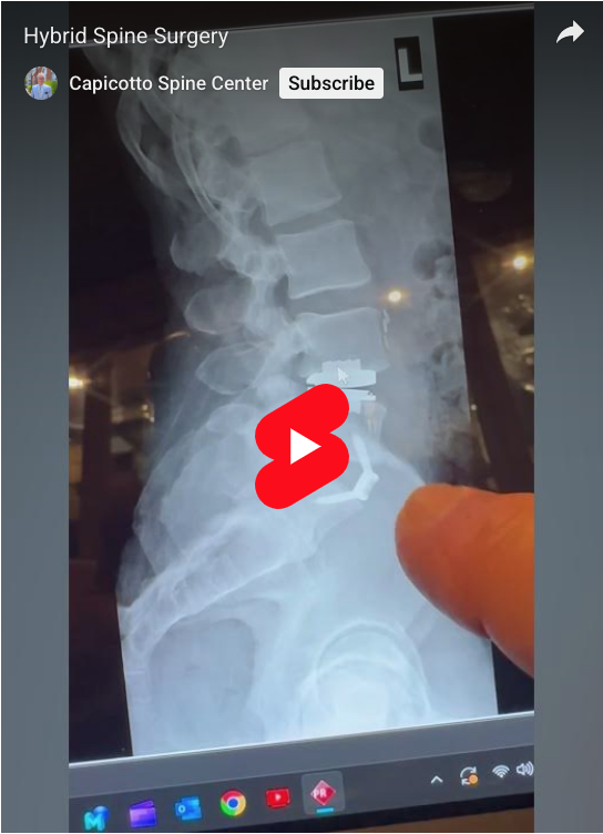 Read more about the article Hybrid Spine Surgery