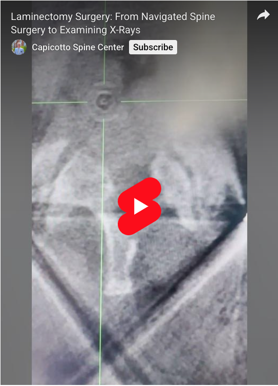 Read more about the article Laminectomy: From Navigated Spine Surgery to Examining X-Rays