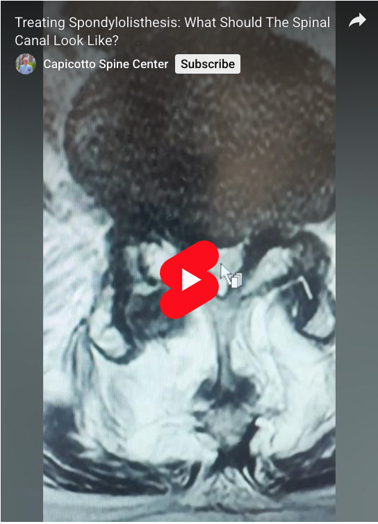 Read more about the article Treating Spondylolisthesis: What Should The Spinal Canal Look Like?