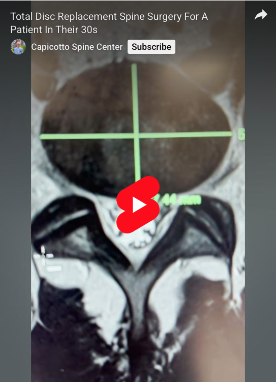 Read more about the article Total Disc Replacement Spine Surgery For A Patient In Their 30s