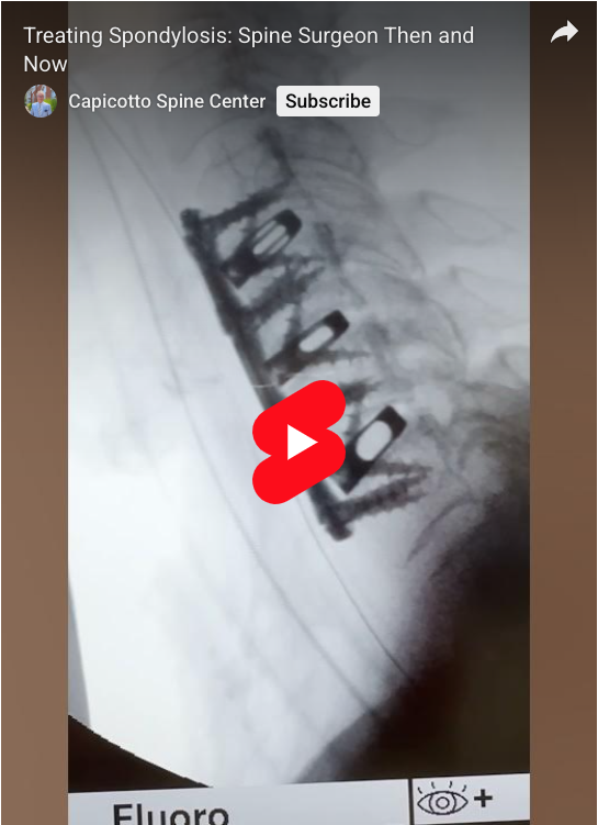 Read more about the article Treating Spondylosis: Spine Surgeon Then and Now