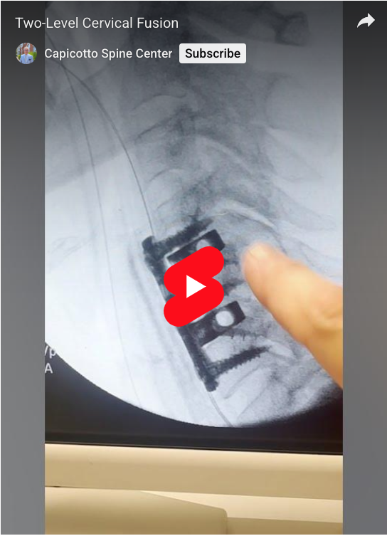 Read more about the article Two-Level Cervical Fusion