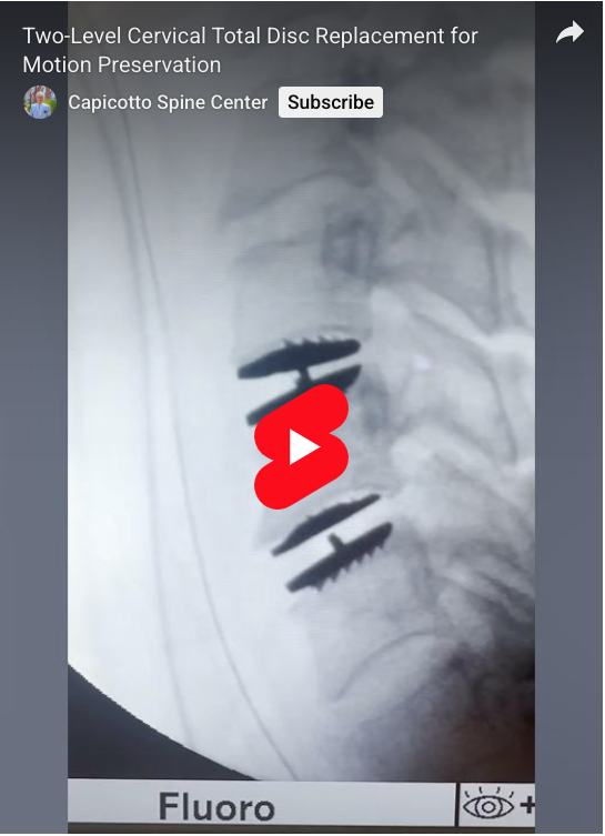 Read more about the article Two-Level Cervical Total Disc Replacement for Motion Preservation