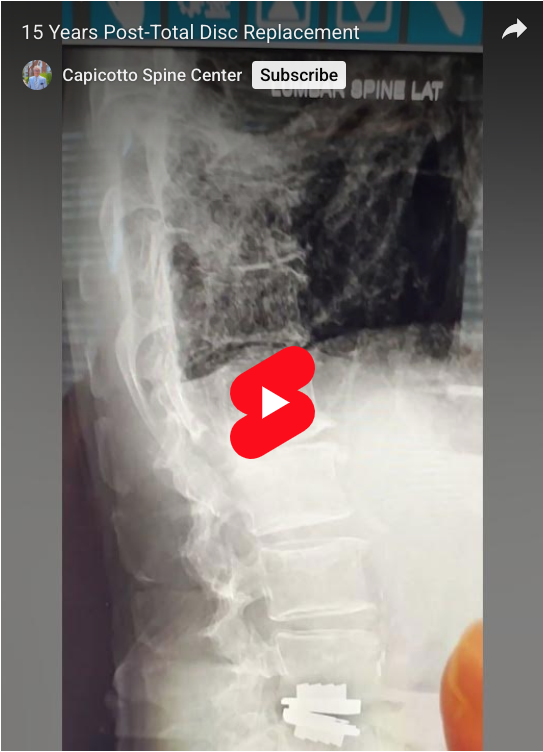 Read more about the article 15 Years Post-Total Disc Replacement