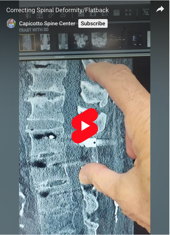 Fingers pointing at part of a spine scan while Dr Capicotto discusses correcting spinal deformity.