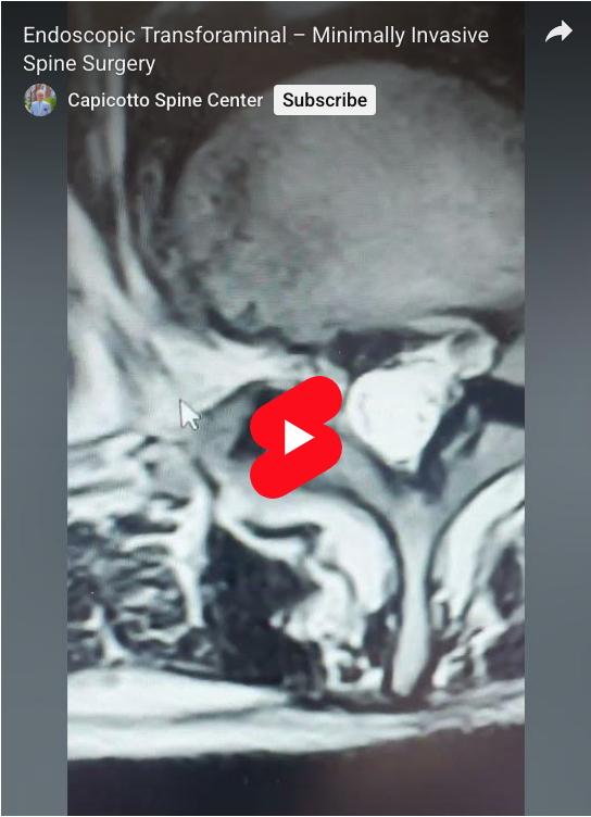 Read more about the article Endoscopic Transforaminal – Minimally Invasive Spine Surgery