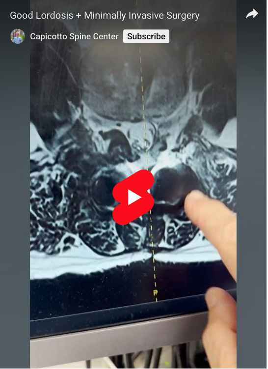 Read more about the article Good Lordosis + Minimally Invasive Surgery