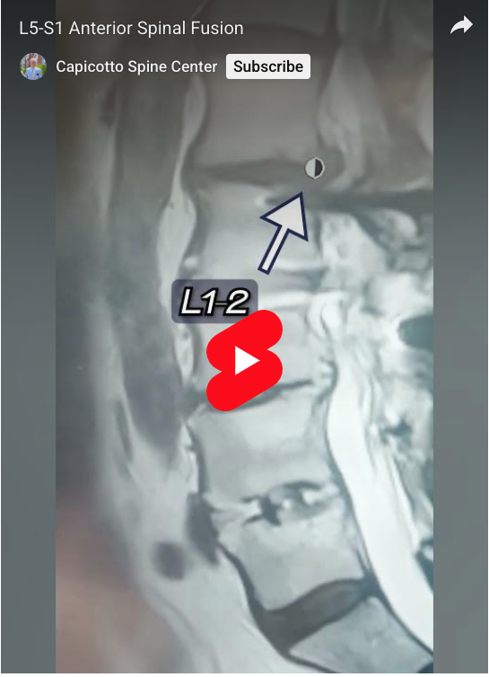 Read more about the article L5-S1 Anterior Spinal Fusion