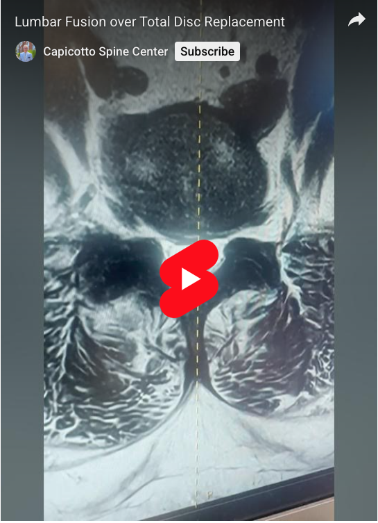 Read more about the article Lumbar Fusion over Total Disc Replacement
