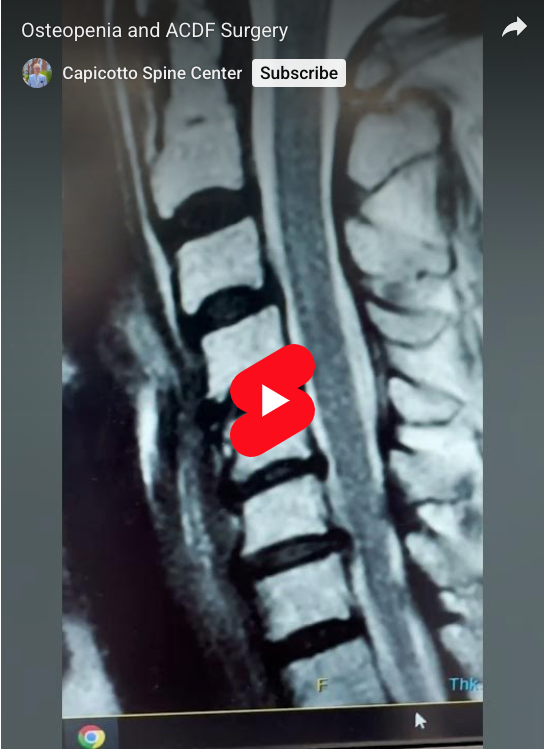 Read more about the article Osteopenia and ACDF Surgery