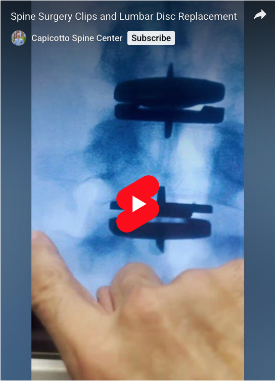 Read more about the article Spine Surgery Clips and Lumbar Disc Replacement
