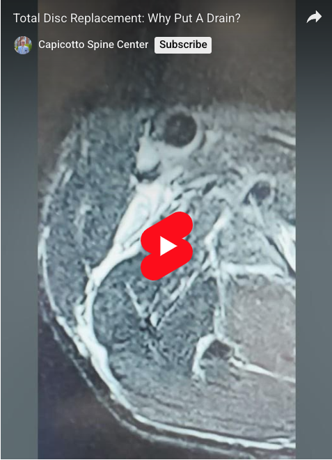 Read more about the article Total Disc Replacement: Why Put A Drain?