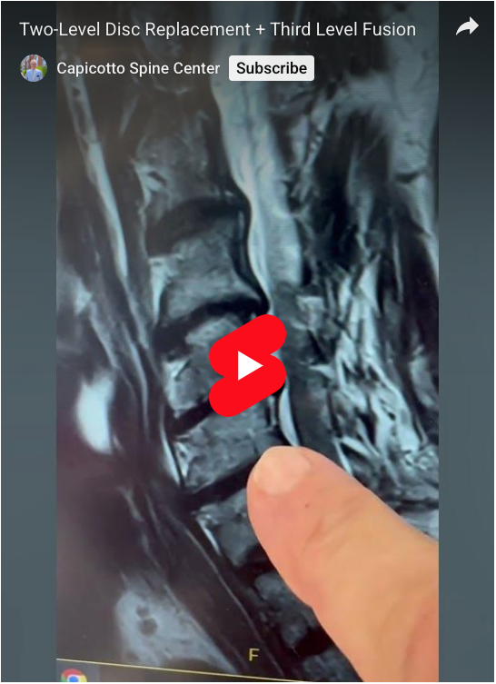 Read more about the article Two-Level Disc Replacement + Third Level Fusion