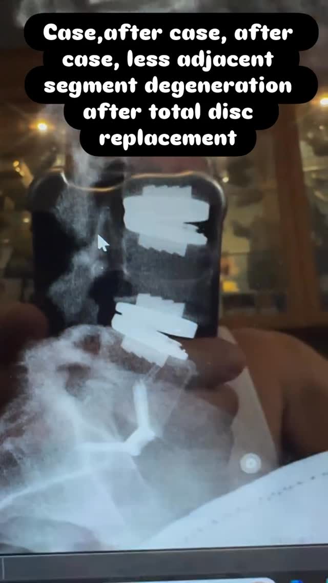 Read more about the article I realize that I am ruffling some feathers among the spine surgery community