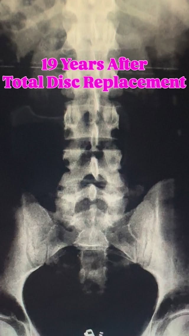 Read more about the article Spine surgeons, you asked for it. Here it is.