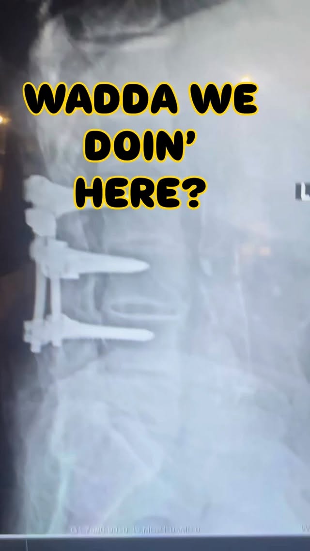 Read more about the article Instrumented Fusions