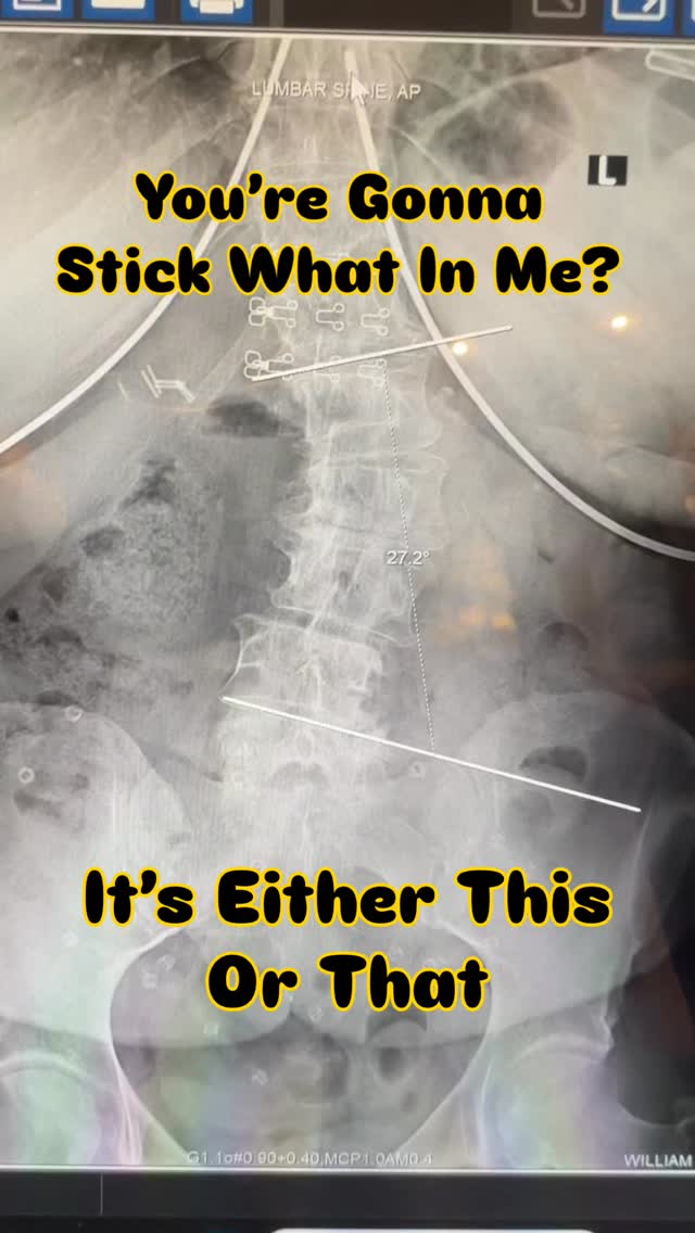 Read more about the article Scoliosis fusions have been around for over 50 years