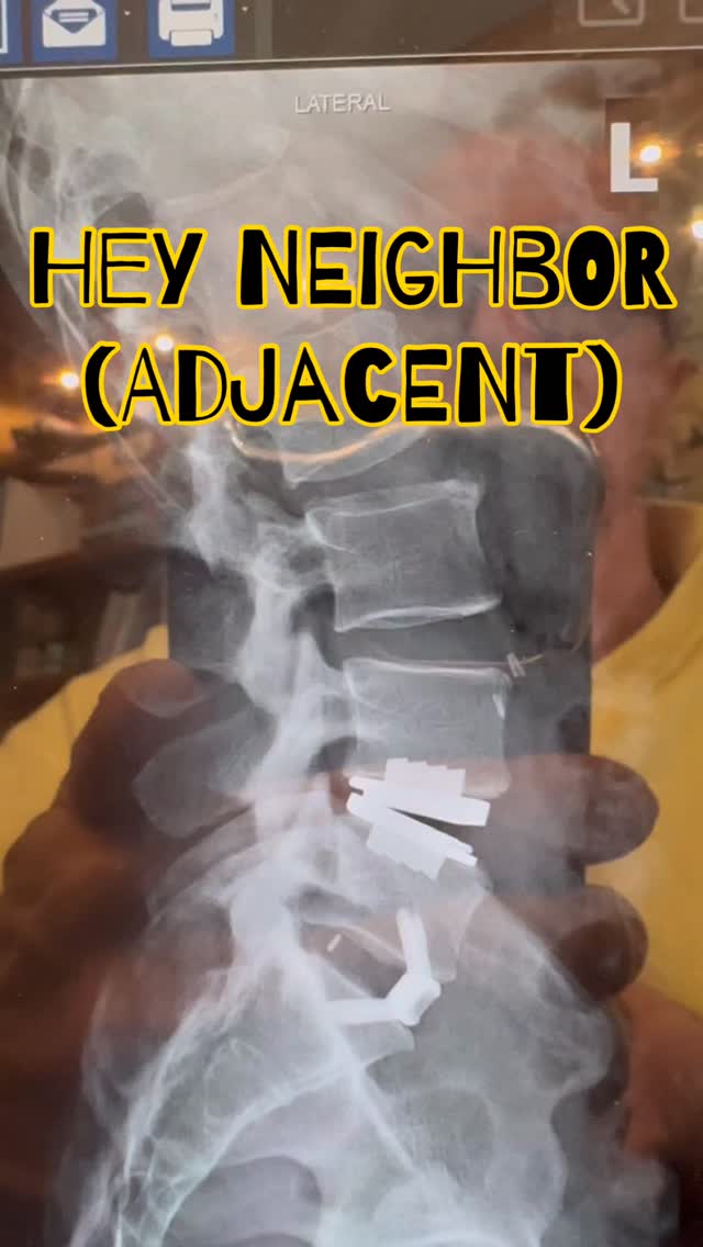 When you need a good neighbor, implant a total disc replacement whenever you can