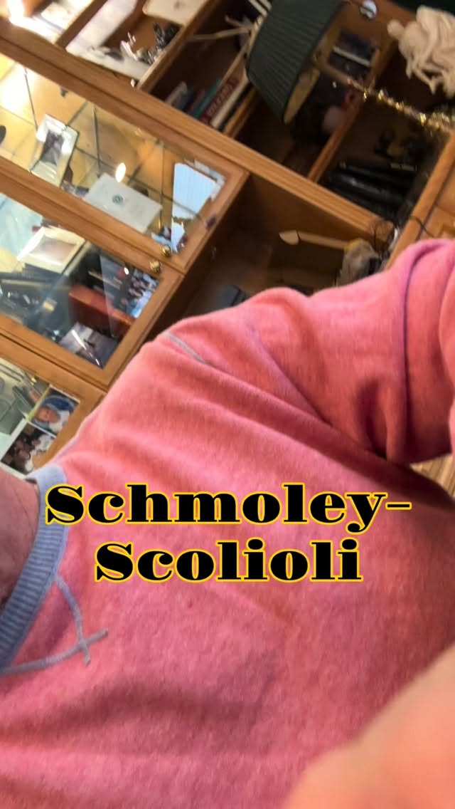 Read more about the article Fairly standard anterior correction for degenerative collapsing scoliosis