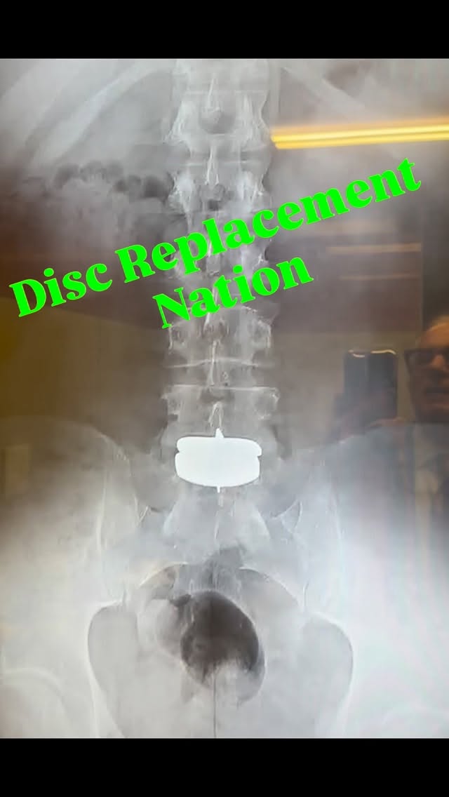 Great function, no pain. Great x-ray.