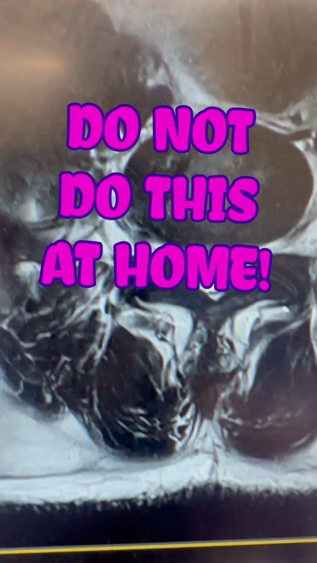 Ultra minimally, invasive endoscopic, L5 S1 discectomy