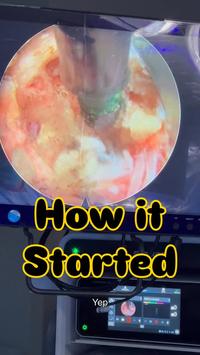 Read more about the article Ultra minimally, invasive lumbar endoscopy to relieve sciatica