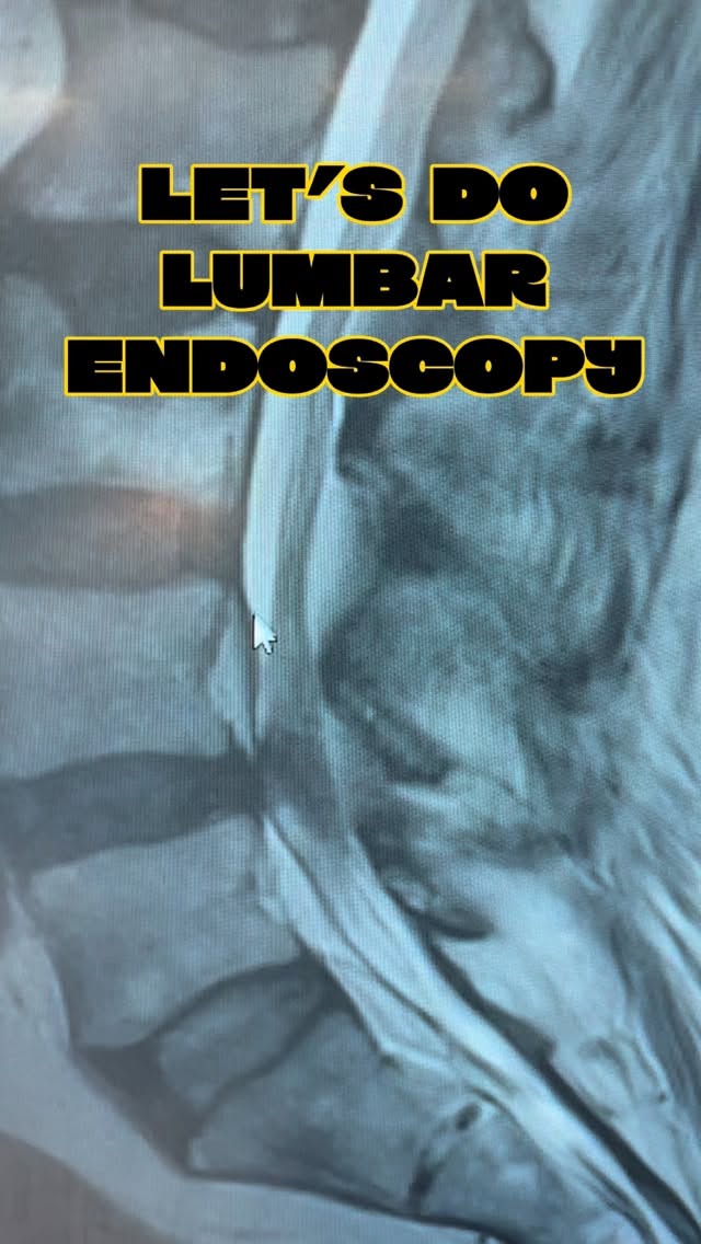 Come to the operating room and perform a lumbar endoscopic surgery with us