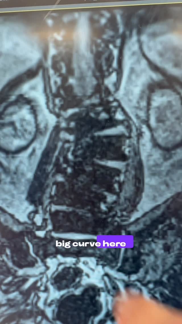 Although we make the incisions much smaller than 10 or 20 years ago, modern day, scoliosis surgery is still quite demanding on the patient and the surgeon
