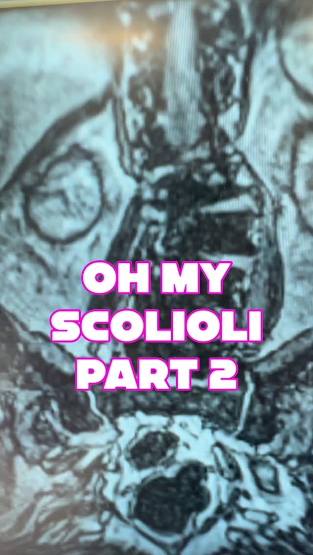 Oh My Scolioli part 2