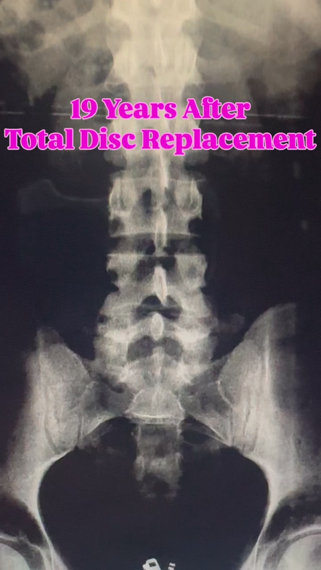 Read more about the article 19 Years After Total Disc Replacement